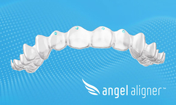 Paris Court Ruling on Discontinued Feature Will Have Minimal Impact on Angelalign Customers
